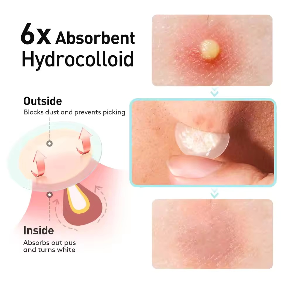 443pcs water-based gel acne pa - Skincare You avis et prix